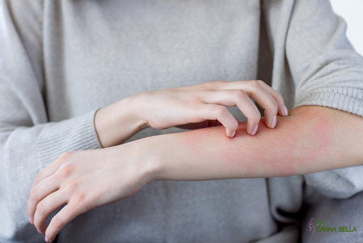 Cómo cuidar la piel después de la exposición solar - Soy Canna Bella