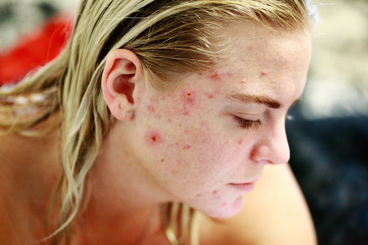 Descubre cuál es tu tipo de acné y que lo causa - Soy Canna Bella